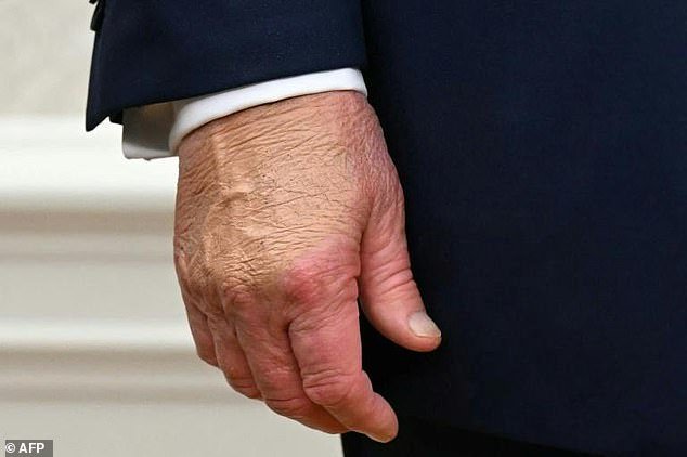 103347581-15231359-A_close_up_shows_US_President_Donald_Trump_s_right_hand_with_hea-a-1_176157588338.jpeg