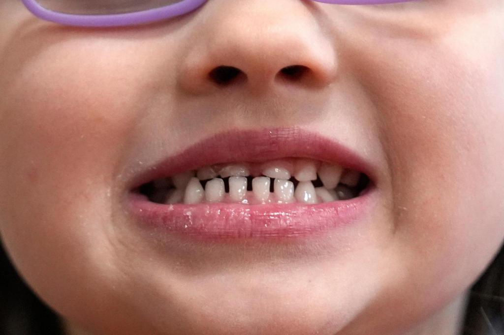 La FDA restringe el uso de suplementos de flúor en niños