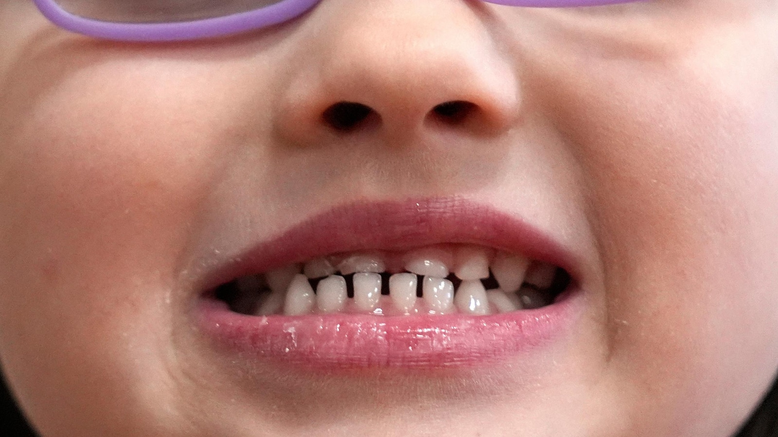 La FDA limita el uso de suplementos de flúor para niños, lo que indica riesgos emergentes para la salud