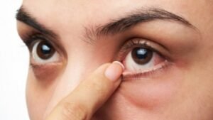 Aprenda sobre el glaucoma, el ‘ladrón silencioso de la vista’, una enfermedad ocular que puede causar ceguera silenciosa