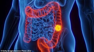 El seguimiento de un innovador ensayo sobre cáncer de intestino muestra cero recurrencia