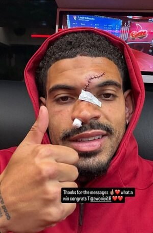 Morgan Gibbs White muestra los resultados de su terrible lesión en la cabeza durante la victoria del Nottingham Forest en el Chelsea, pocos días antes del partido de vuelta de la semifinal de la Europa League contra el Aston Villa.